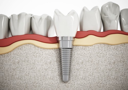 when can i wear my flipper after dental implant_3