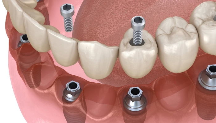 When Can I Exercise After Dental Implant?