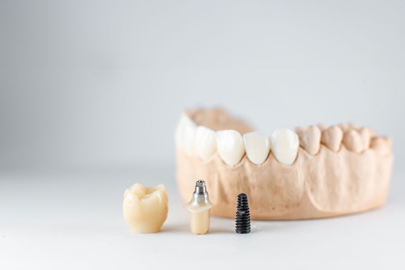 what happens dental implant comes out_1