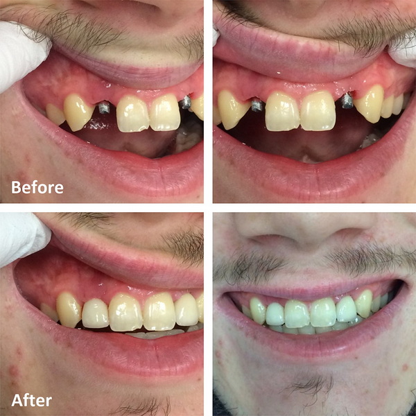 what to do before dental implant surgery_2