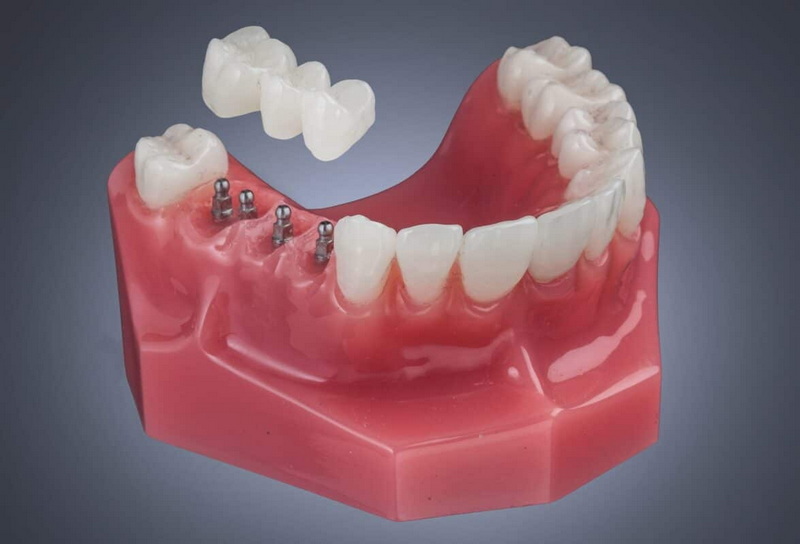 dental implant brand is the best_2