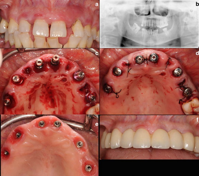 what to do when a dental implant falls out_1