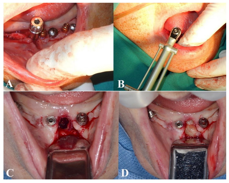 Why Did My Dental Implant Fail?