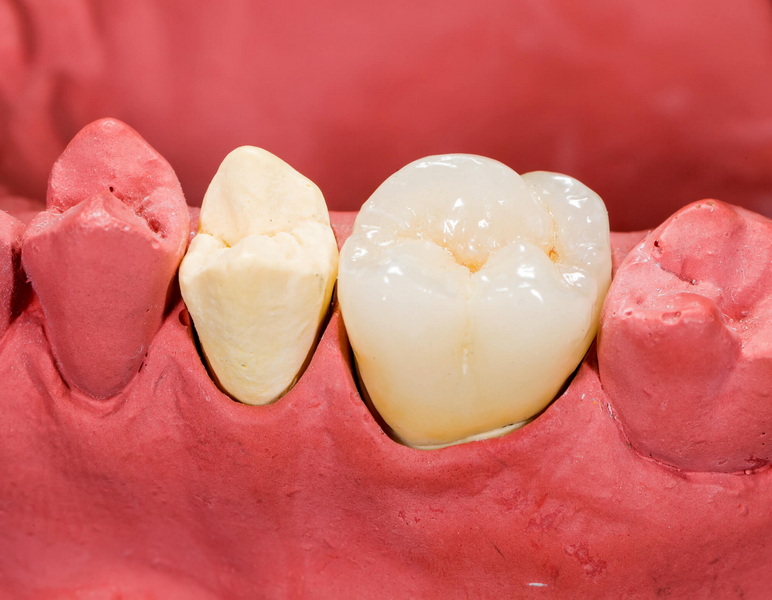 ucla abutment in dental implant_1