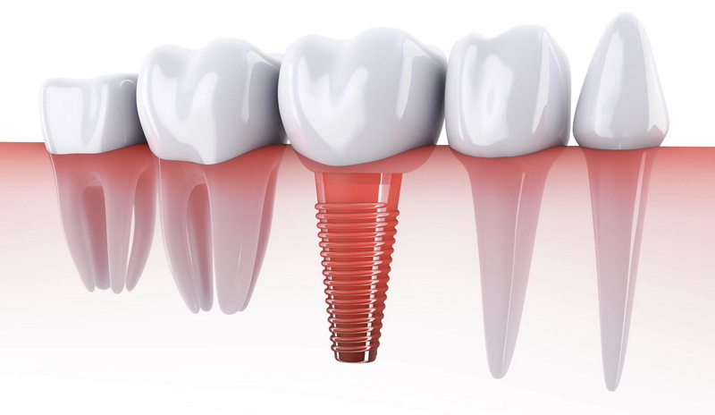 what is a torque test dental implant_2