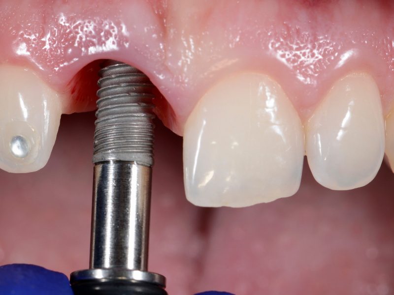 dental implant torque test_3