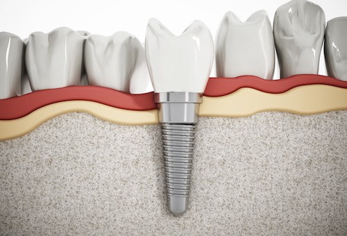 a dental implant to fail_1