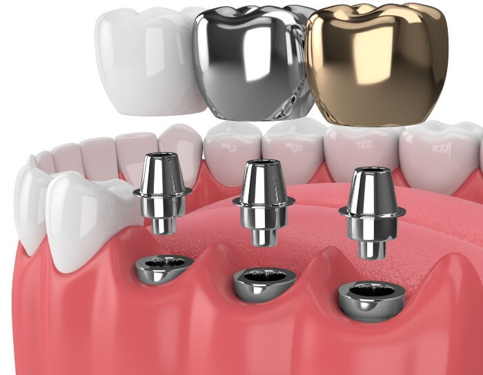 What Are Dental Implant Posts Made of?