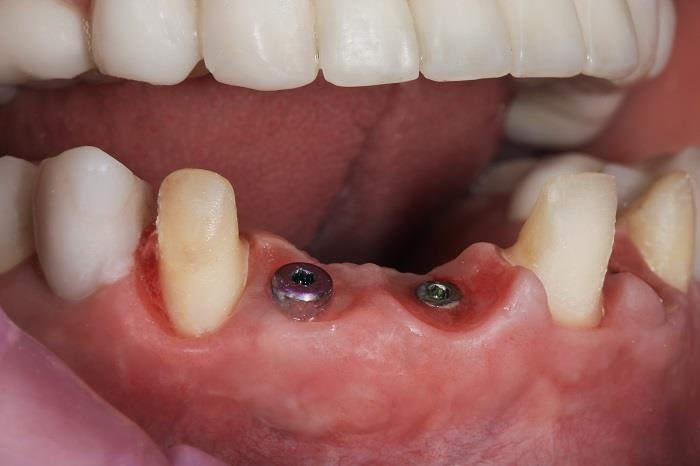 get a dental implant_3