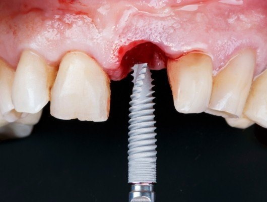 What Are The Symptoms of A Dental Implant Rejection?