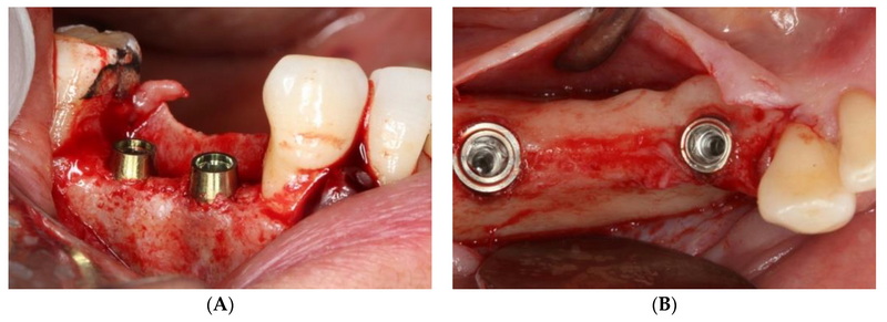 Is Dental Implant A Surgery?
