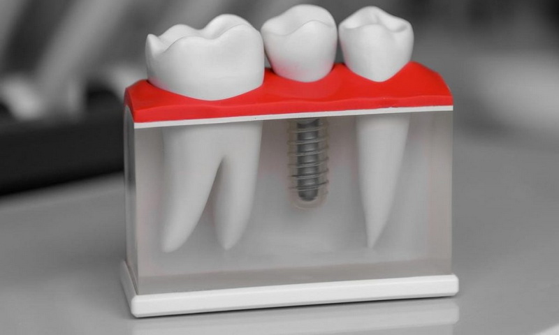 how long does dental implant healing take_22
