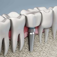 //iirorwxhloqjli5p.ldycdn.com/cloud/lkBpkKloljSRrlinlqmkjq/abutment-screw-loosening-in-single-implant-restorations.jpg