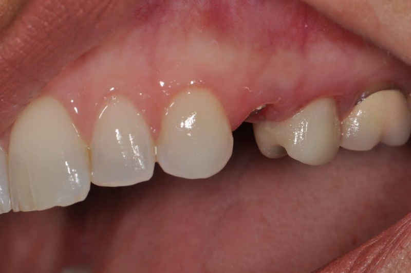 What Is A Screwless Dental Implant?