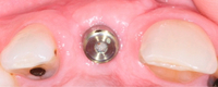 //iirorwxhloqjli5p.ldycdn.com/cloud/lkBpkKloljSRrljkjmijjo/difference-between-healing-cap-and-healing-abutment.jpg