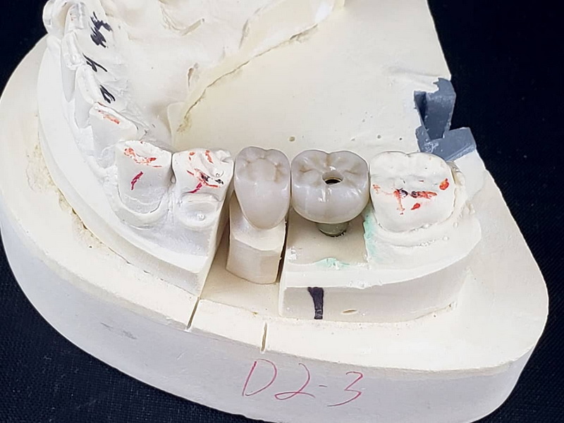 dental abutment procedure