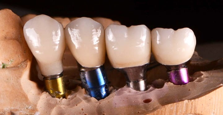 core-vent dental abutment