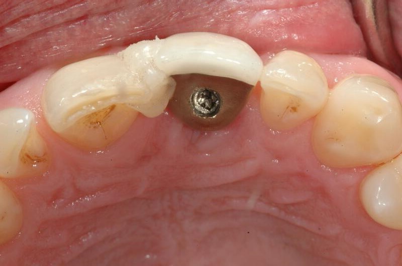What Causes Gum Discomfort After Abutment Surgery?