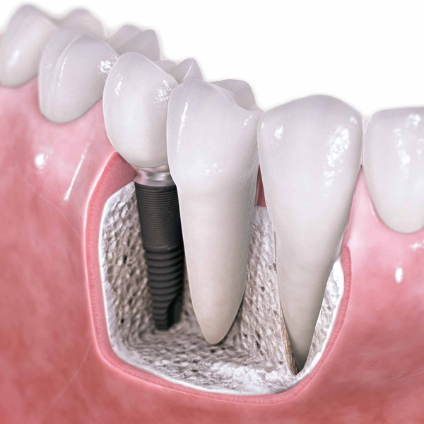 Can I Order An Ishell Custom Healing Abutment for My Implant?