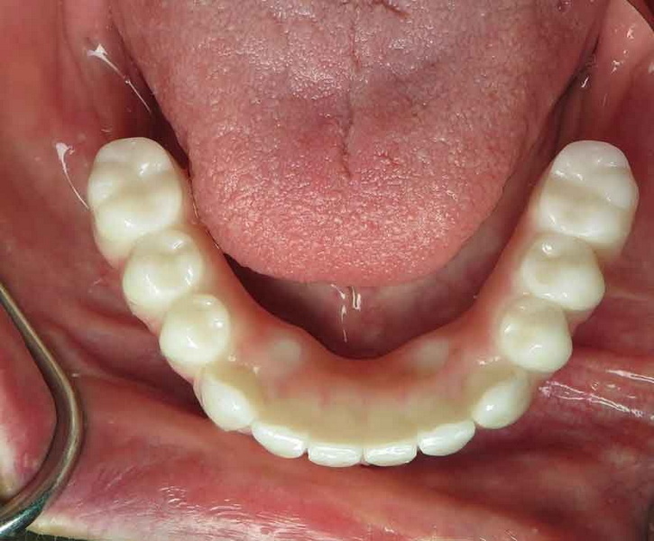 can reaction to dental implant jeopardize knee replacement