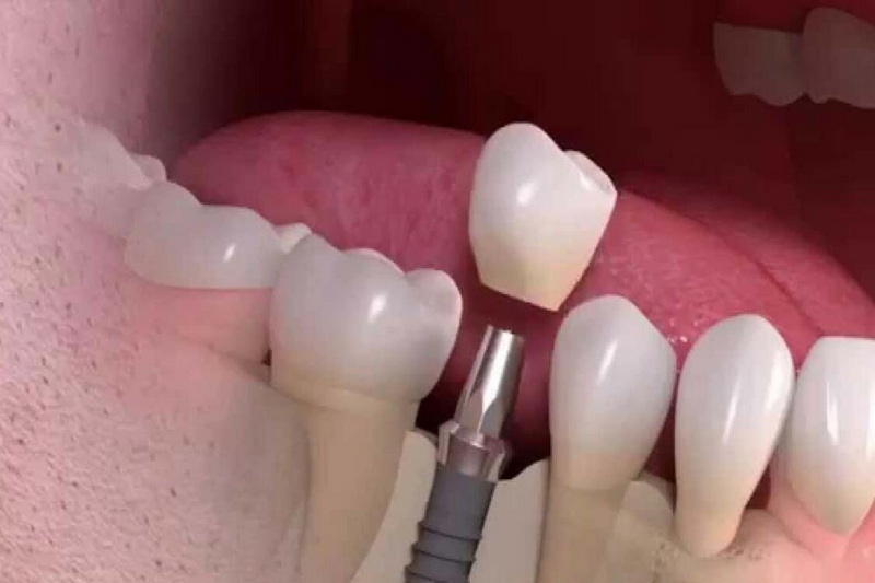 Can Sinus Infection Affect Dental Implant?