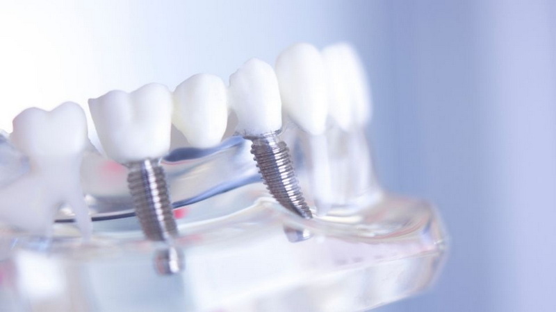 can stains on dental implant be removed