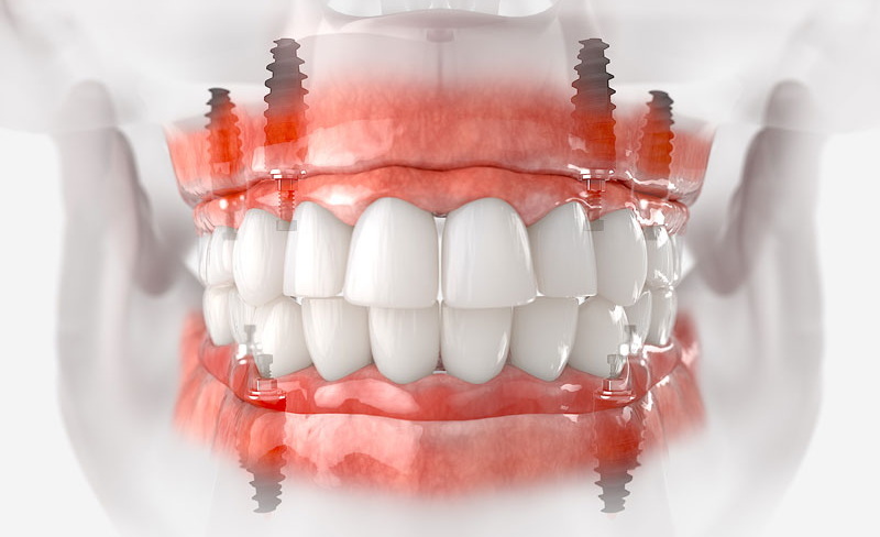 Can You Be Put To Sleep During A Dental Implant?