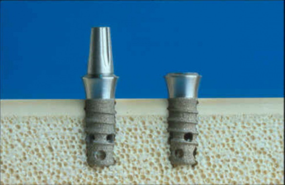 spline dental abutment