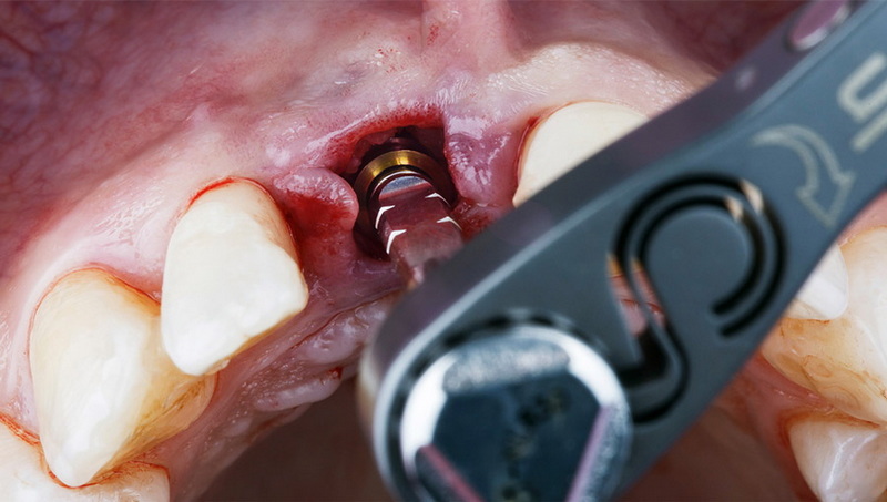 can a dental implant be reshaped