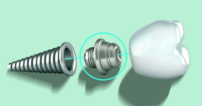 Can I Eat Normally With A Dental Implant Healing Abutment?
