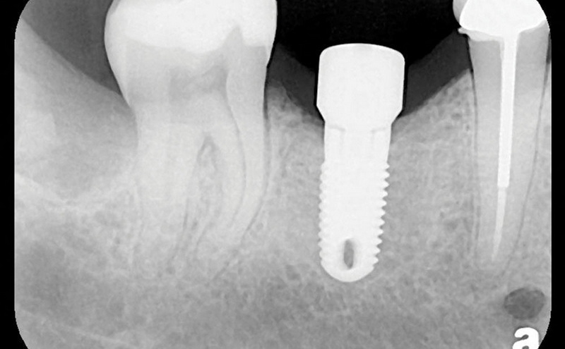 How To Care For An Implant Healing Abutment Properly?