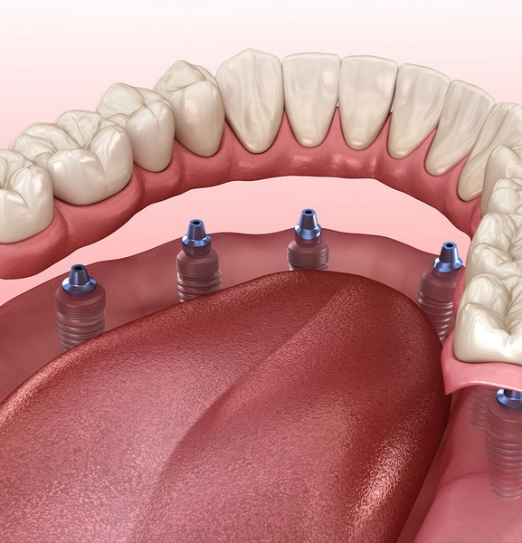 can i fly with osseointegration dental implant going on