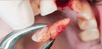 //iirorwxhloqjli5p.ldycdn.com/cloud/lkBpkKloljSRrlokornmjq/can-you-drink-from-a-straw-after-dental-implant.jpg
