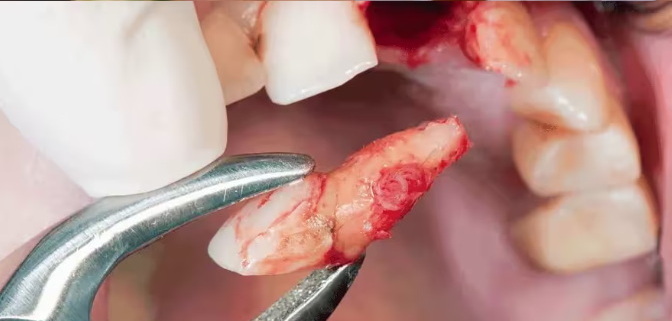 can you drink from a straw after dental implant