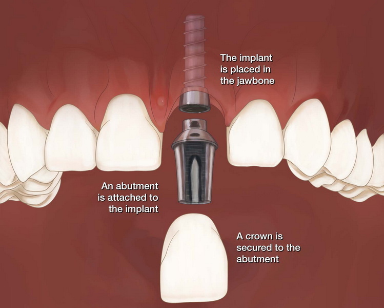 Are Dental Implant Permanent?