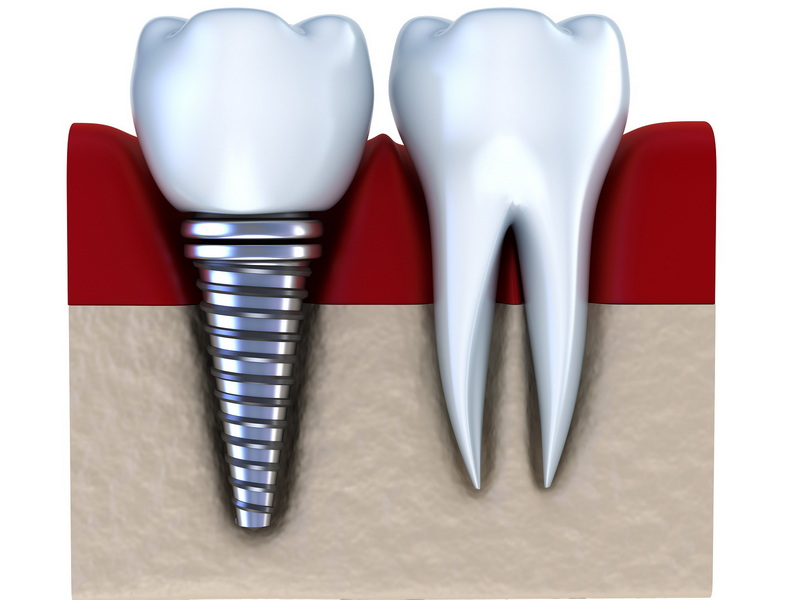 can you remove a crown from a dental implant