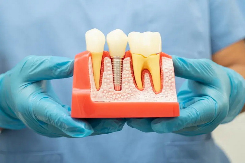 can i kiss someone a week after a dental implant