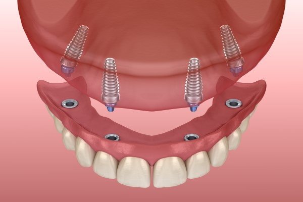 can i play golf after dental implant
