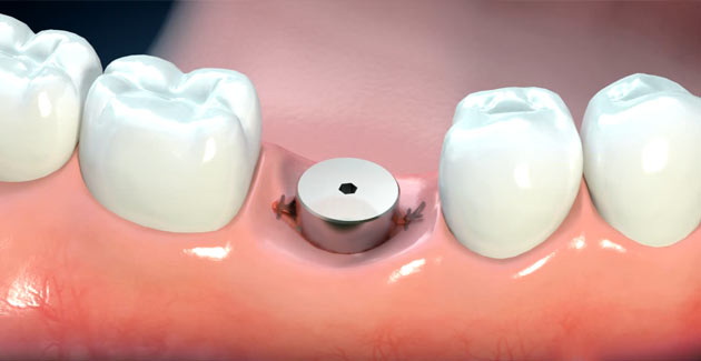 Can A Cover Screw Be Replaced With A Healing Abutment?