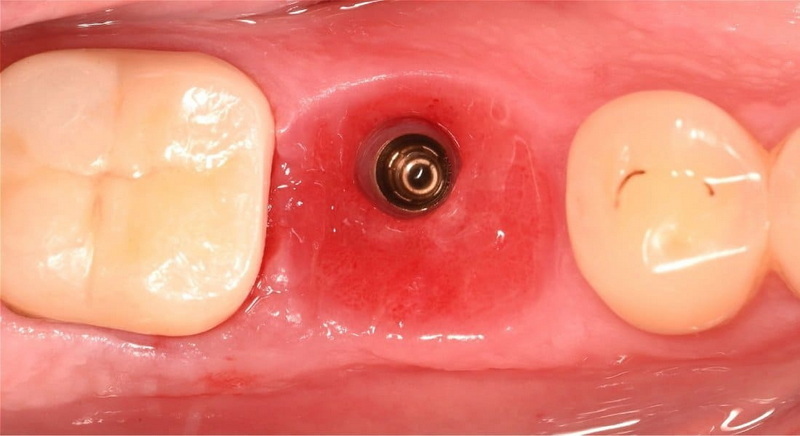 What Is A Healing Abutment Implant And How Does It Work?
