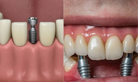 //iirorwxhloqjli5p.ldycdn.com/cloud/lkBpkKloljSRrlqljpjojq/abutment-screw-dimensions.jpg