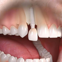 //iirorwxhloqjli5p.ldycdn.com/cloud/lkBpkKloljSRrlqllloljq/can-you-go-through-a-metal-detector-with-dental-implant.jpg