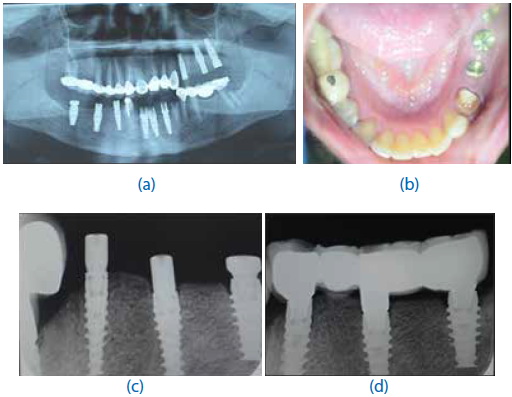 are there any options for dental implant