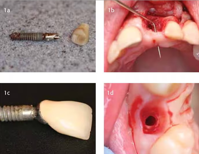 can a dental implant effect adjacent teeth