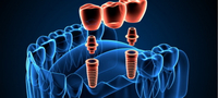 //iirorwxhloqjli5p.ldycdn.com/cloud/lkBpkKloljSRrlrlikqljo/implant-cover-screw-vs-healing-abutment.jpg