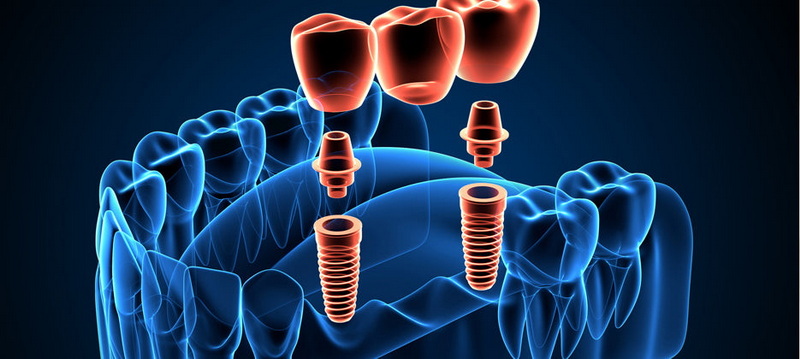 implant cover screw vs healing abutment
