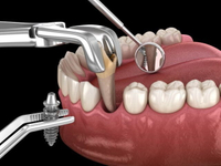 //iirorwxhloqjli5p.ldycdn.com/cloud/lkBpkKloljSRrlrliqoijo/straumann-abutment-screw-torque.jpg