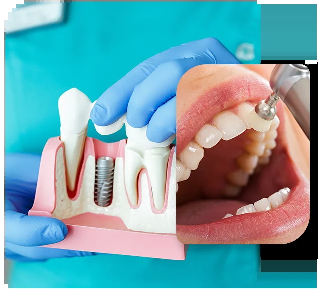 What Are The Chances of Dental Implant Failure?