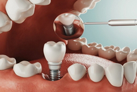 //iirorwxhloqjli5p.ldycdn.com/cloud/llBpkKloljSRiliinjqkjo/megagen-healing-abutment.jpg