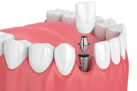 //iirorwxhloqjli5p.ldycdn.com/cloud/llBpkKloljSRiliiormjjo/healing-abutment-sizes.jpg